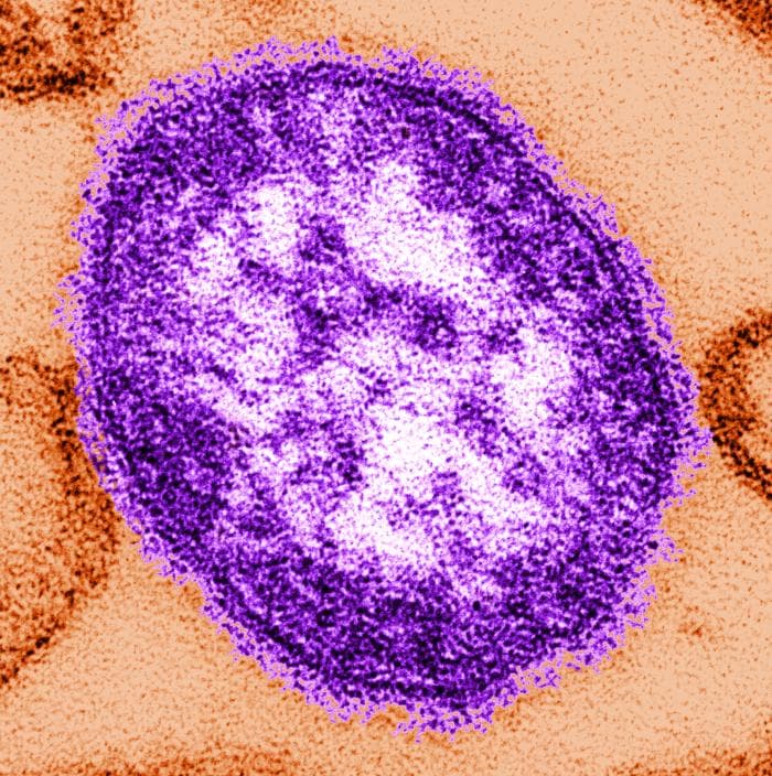 Archival digitally colorized electron micrograph of a measles virus particle.
